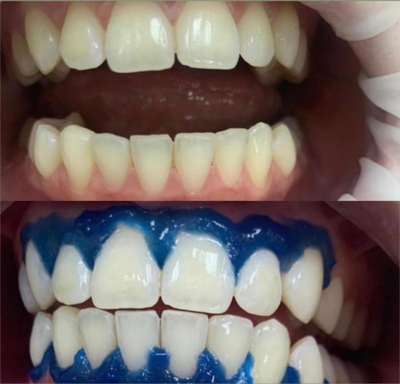 Улыбайтесь чаще! Стоматология «SMILE FOR YOU» дарит скидку до 40% Улыбайтесь чаще! Стоматология «SMILE FOR YOU» дарит скидку до 40%